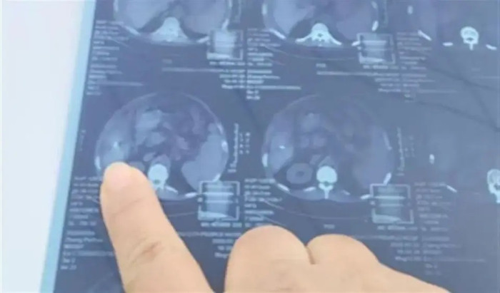 Một người đàn ông sau ca phẫu thuật bị sót lại cây kim 15mm trong gan. (Ảnh minh họa: news.qq)