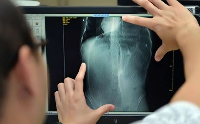 Sót cây kim 15mm trong gan bệnh nhân ung thư sau phẫu thuật, bác sĩ nói không thể lấy ra Ảnh 2