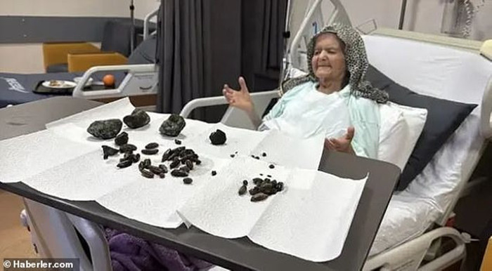 Bà cụ lên cơn đau bụng dữ dội, bác sĩ phẫu thuật kinh hãi khi lôi ra hàng chục dị vật bên trong Ảnh 2