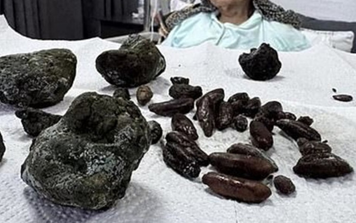 Bà cụ 92 tuổi lên cơn đau bụng dữ dội, bác sĩ phẫu thuật kinh hãi khi lôi ra hàng chục dị vật bên trong Ảnh 2