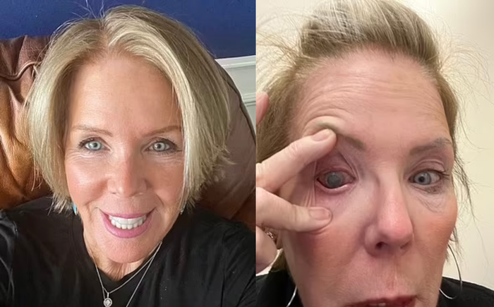 Người phụ nữ bị đau mắt dữ dội vì đeo kính áp tròng khi dạy bơi cho trẻ em. (Ảnh: Daily Mail)