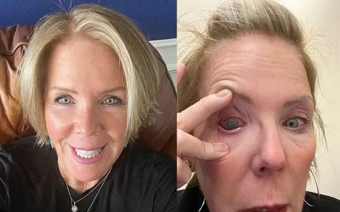 Người phụ nữ bị mù vĩnh viễn vì một sai lầm khi dùng kính áp tròng Ảnh 2