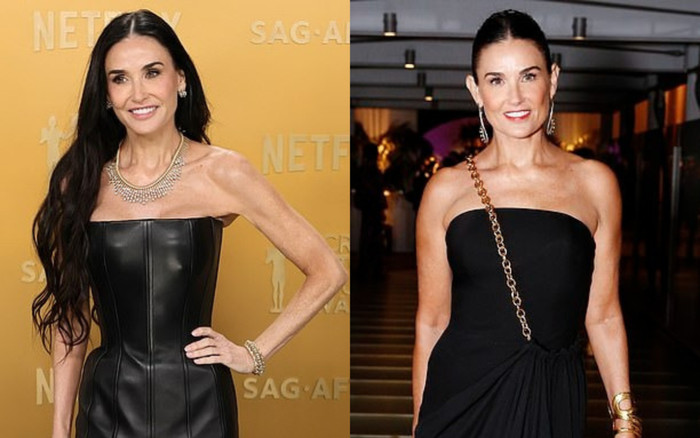 Hội chứng 'Ozempic Arms' và những hệ lụy của việc giảm cân quá nhanh Ảnh 2