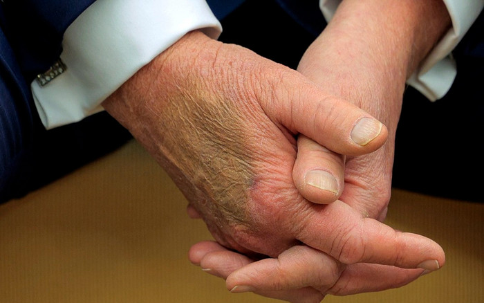 Xuất hiện vết bầm gây bàn tán trên tay Tổng thống Trump Ảnh 2