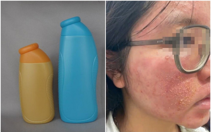 Cô gái 25 tuổi ngứa rát mặt sau khi dùng mỹ phẩm được bạn trai tặng dịp Valentine Ảnh 2