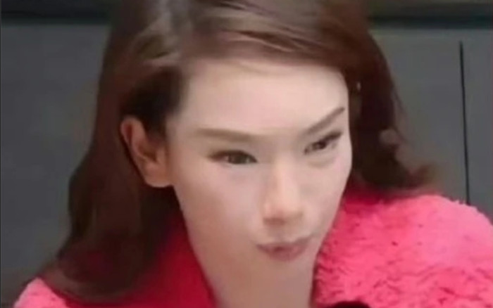 Diễn viên Thích Vy thừa nhận tiêm botox quá tay, gương mặt cứng đờ khiến fan sốc Ảnh 2