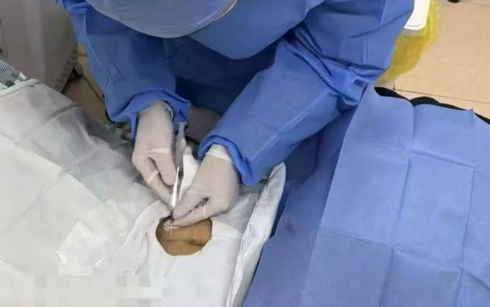 Hy hữu cấy chip cai rượu vào bụng người phụ nữ, chi phí 60 triệu Ảnh 2