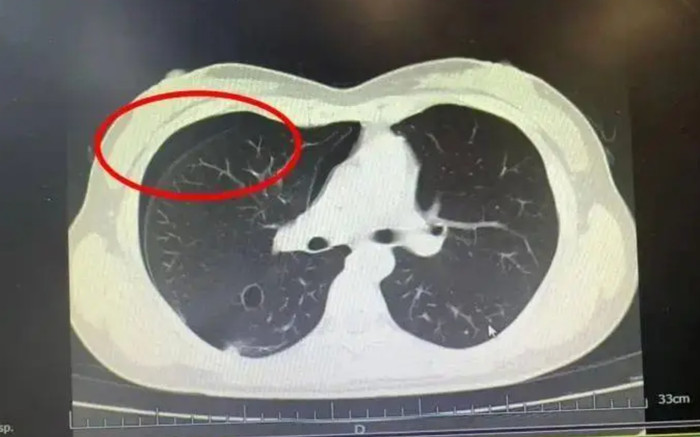 Người phụ nữ phải nhập viện cấp cứu, sững sờ trước kết quả chụp CT sau khi giảm 10 kg Ảnh 2