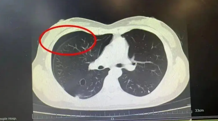 Kết quả chụp CT cho thấy người phụ nữ bị tràn khí màng phổi tự phát. (Ảnh: Sohu)
