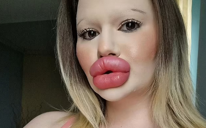 Chi nửa tỷ, cô gái tiêm 30 lần để có 'đôi môi lớn nhất thế giới' Ảnh 2