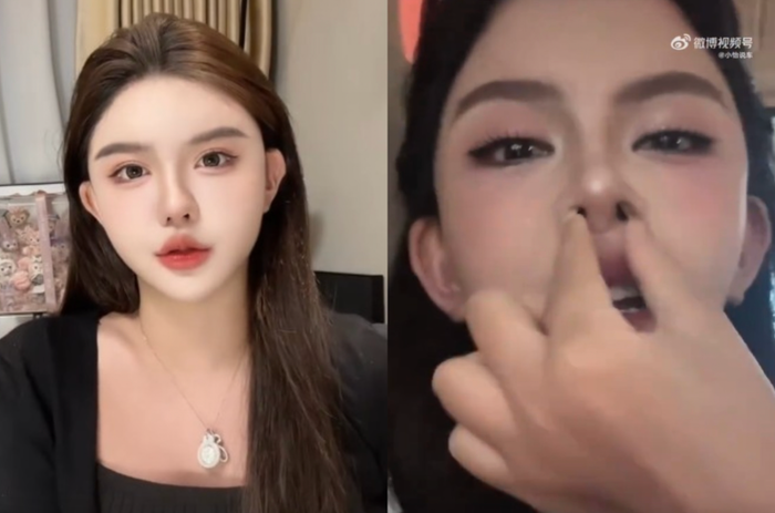 Ngôi sao mạng Han Anran 'dao kéo' phần mũi nhiều lần nên gây khó thở. (Ảnh: China Time)