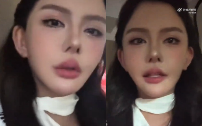 Gương mặt đơ cứng của Han Anran sau khi can thiệp phẫu thuật thẩm mỹ. (Ảnh: China Time)