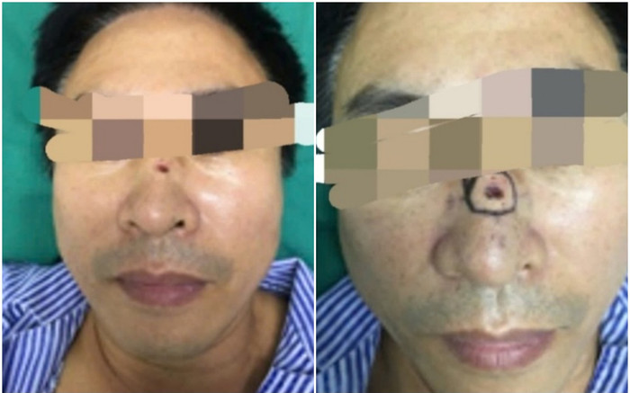 Người đàn ông tự hào nốt ruồi ở sống mũi 'phong thuỷ tốt', đi khám tá hoả mắc ung thư Ảnh 2