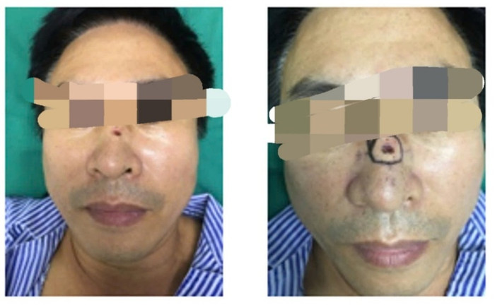 Bệnh nhân xuất hiện một vết loét nhỏ ở vị trí nốt ruồi trên sống mũi.&nbsp;