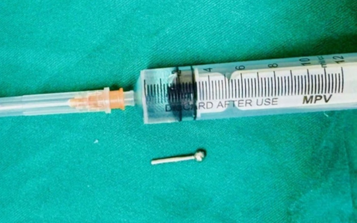 Đeo khuyên lưỡi, cô gái 19 tuổi phải nhập viện vì nuốt xuống dạ dày trong lúc ăn tối Ảnh 2