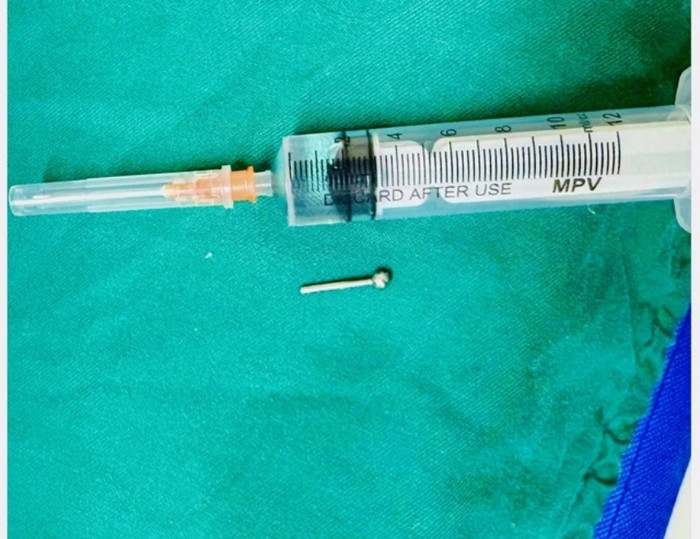 Sau 90 phút, các bác sĩ đã gắp được chiếc khuyên lưỡi ra khỏi dạ dày cô gái.