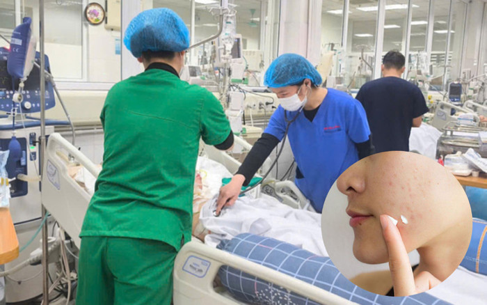 Cô gái 15 tuổi phải thở máy, lọc máu sau khi thoa thuốc trị mụn không rõ nguồn gốc Ảnh 2