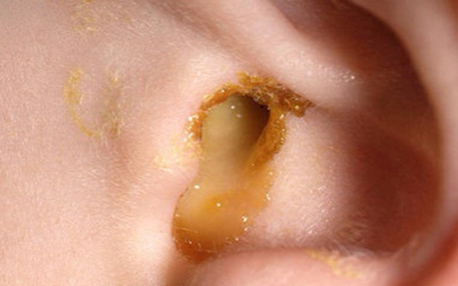 Viêm tai giữa âm thầm tàn phá, người phụ nữ đối diện nguy cơ điếc và liệt mặt Ảnh 2