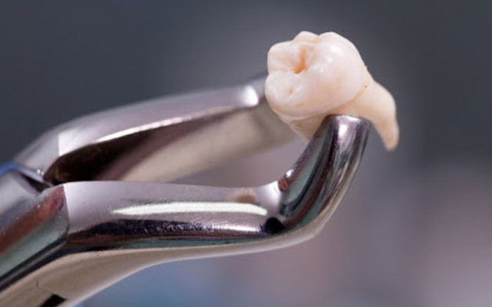 Người phụ nữ bất tỉnh sau khi nhổ răng, 2 tháng điều trị vẫn nguy kịch Ảnh 2