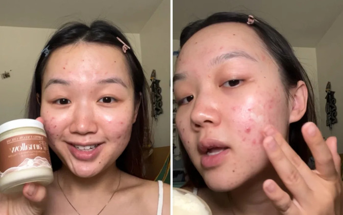 'Botox tự nhiên' – Xu hướng làm đẹp tại nhà trên mạng xã hội, liệu có thực sự hiệu quả? Ảnh 2