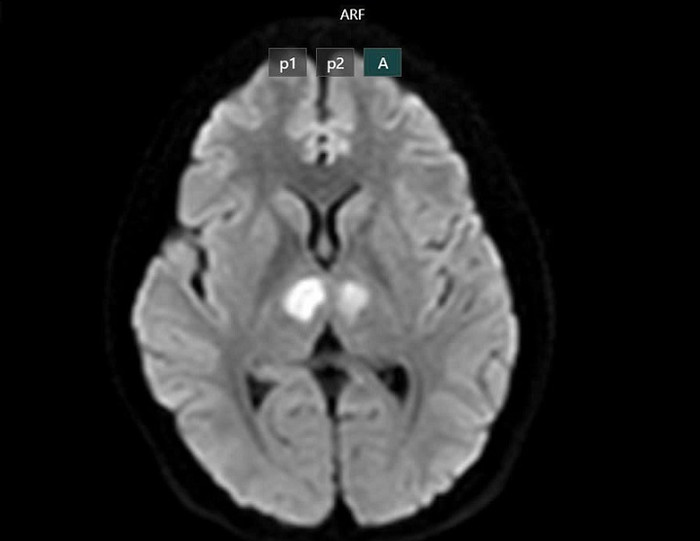 Phim chụp cho thấy não bệnh nhân bị tổn thương vùng đồi thị hai bên. Ảnh: BVCC