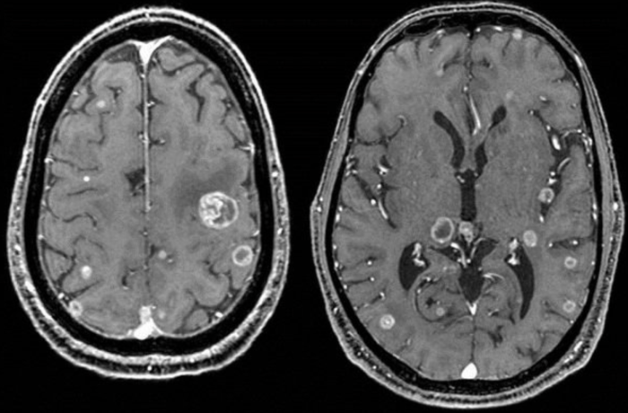Hình ảnh ung thư não trên CT Scan. Ảnh: Sưu tầm