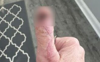 Xuất hiện dấu vết lạ trên tay sau khi làm móng, người phụ nữ đi khám thì mắc căn bệnh nguy hiểm Ảnh 2