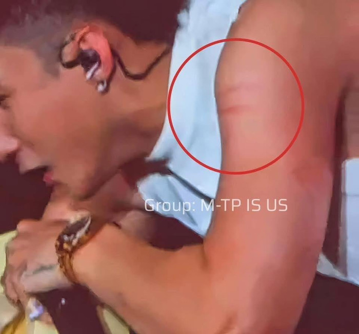 Tay của Sơn Tùng bị rướm máu, nổi rõ vết cào do fan cuồng để lại sau màn 'tấn công' trên sân khấu. Ảnh: Sưu tầm