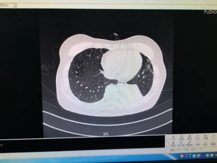 Trước đó, một người phụ nữ được chẩn đoán mắc aspergillus phế quản phổi xâm lấn vì chứa số lượng lớn nấm mốc trong cơ thể. (Ảnh: Sohu)