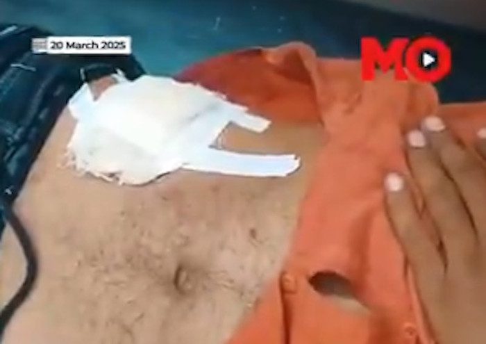 Người đàn ông lên mạng học cách tự mổ ruột thừa tại nhà, gặp biến chứng nghiêm trọng sau đó Ảnh 2