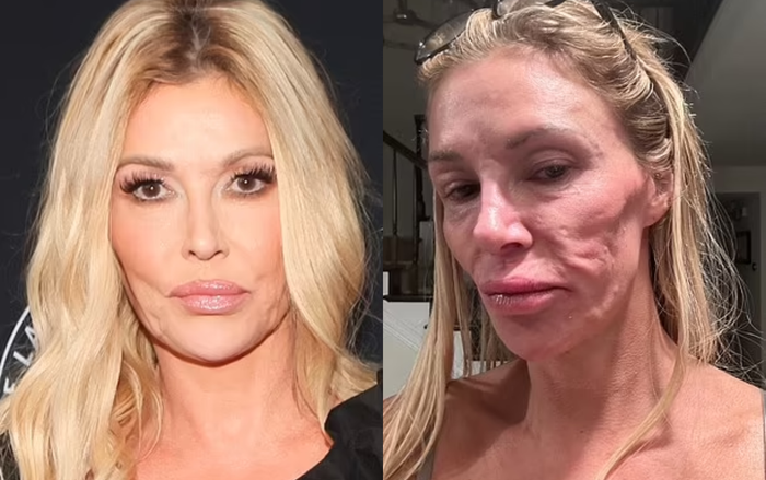 Chi hơn 70.000 USD vẫn bất lực: 'Cuộc chiến' 5 năm sửa mặt biến dạng vì filler của sao truyền hình Ảnh 2