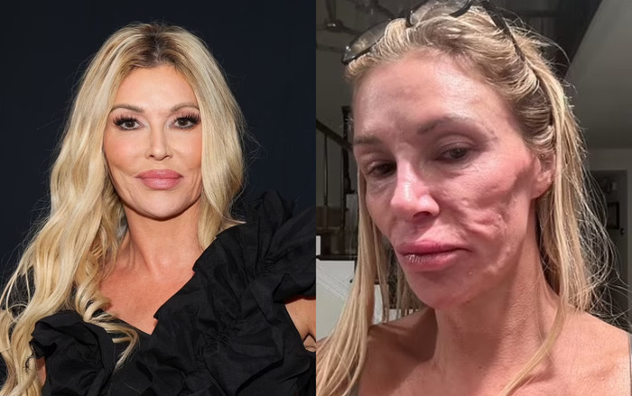 Chi hơn 70.000 USD vẫn bất lực: 'Cuộc chiến' 5 năm sửa mặt biến dạng vì filler của sao truyền hình Ảnh 2