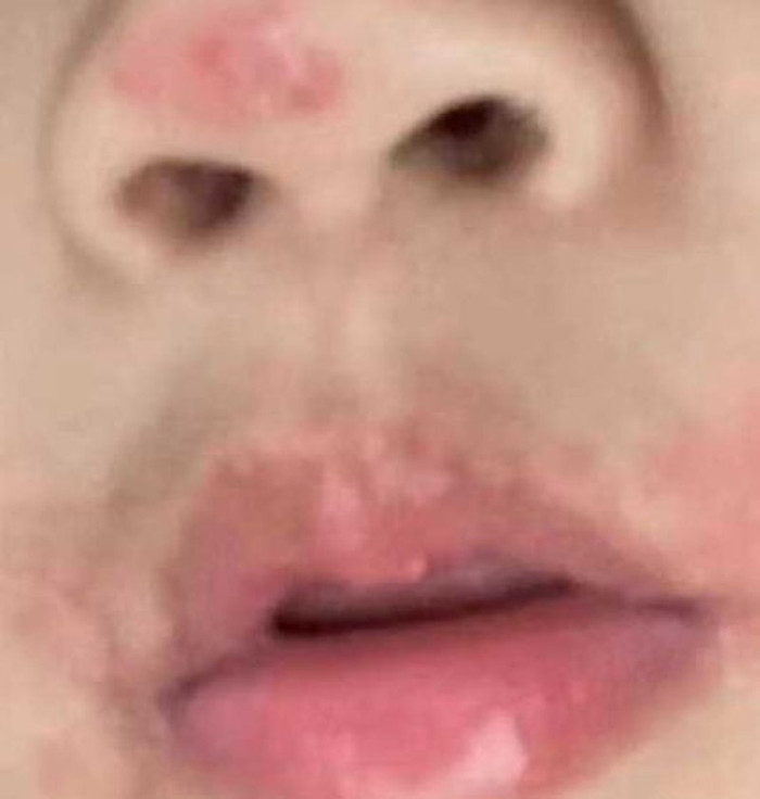 Cô Huang cho biết bệnh tình của mình đã kéo dài 8 năm, không thể chữa khỏi hoàn toàn mà vẫn tái đi tái lại.