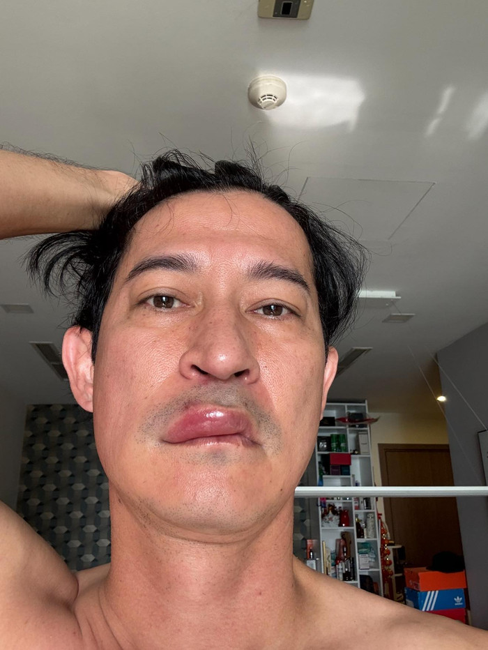 Huy Khánh bất ngờ đăng tải hình ảnh cho thấy khuôn mặt bị sưng bất thường, đặc biệt là ở vùng môi. Ảnh: FBNV