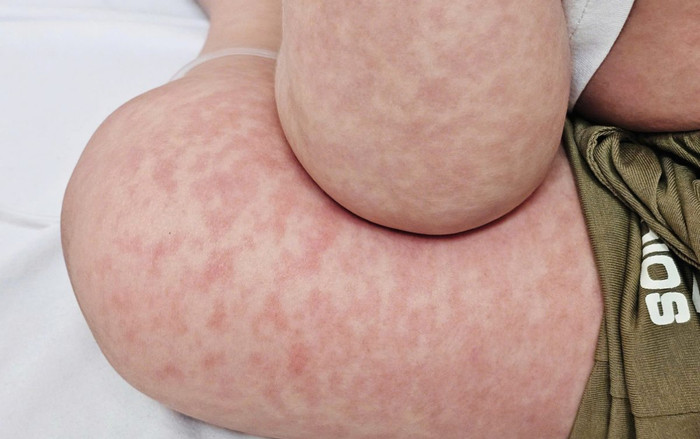 Dịch sởi bùng phát mạnh tại Mỹ, hàng trăm ca nhiễm chỉ trong một tuần Ảnh 2
