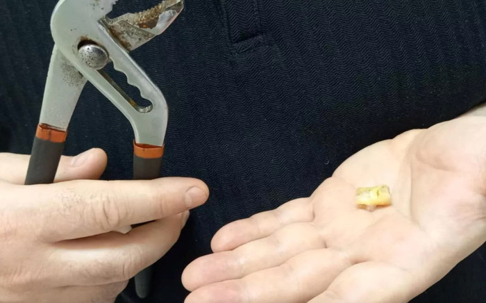 Tự nhổ răng bằng cờ lê, người đàn ông gặp biến chứng nặng Ảnh 2