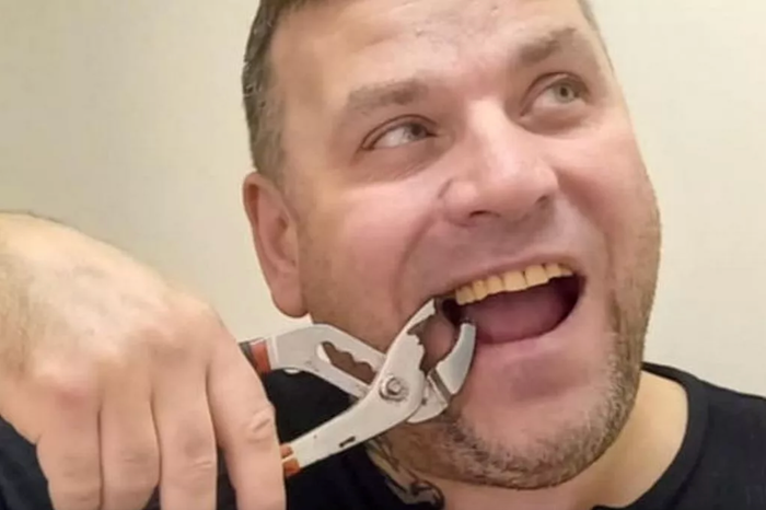 Tự nhổ răng bằng cờ lê, người đàn ông gặp biến chứng nặng Ảnh 1