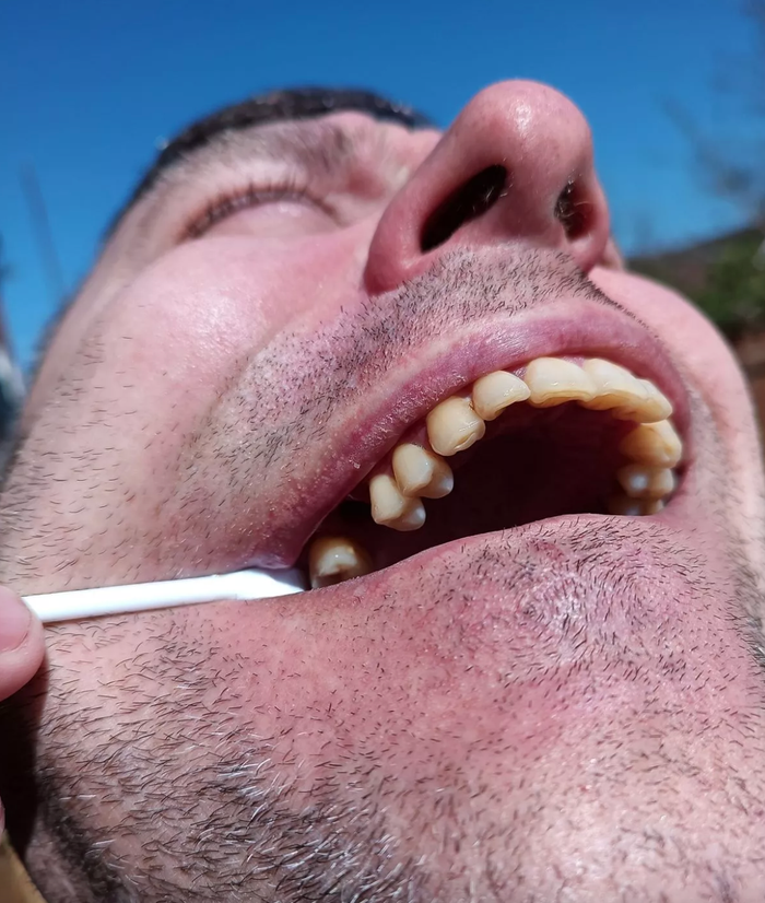 Tự nhổ răng bằng cờ lê, người đàn ông gặp biến chứng nặng Ảnh 2