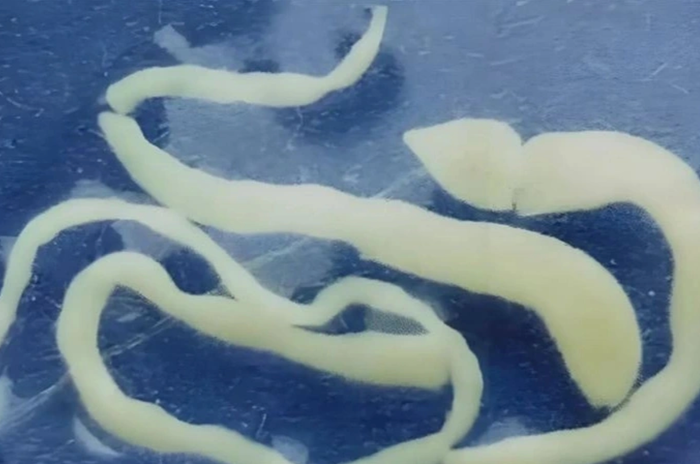 Giun đầu gai có chiều dài tới 5cm được lấy ra từ đầu của cô gái. Ảnh: Aboluowang