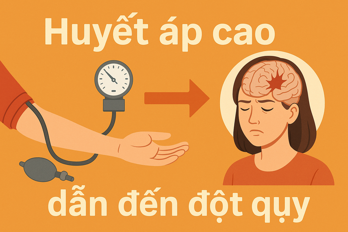 Huyết áp cao là thủ phạm số 1 dẫn đến đột quỵ.