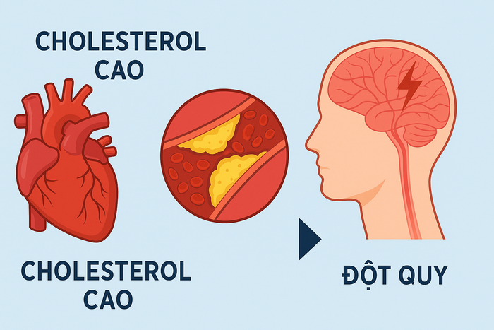 Cholesterol và triglyceride cao gây tích tụ mảng bám trong lòng mạch, khiến máu khó lưu thông, tăng nguy cơ tắc mạch não. 