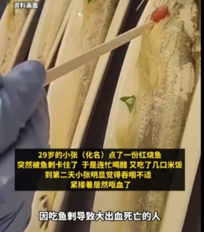 Thanh niên 29 tuổi tử vong vì hóc xương cá dài 5cm Ảnh 1