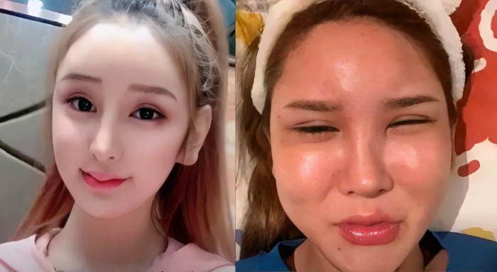 Đào Hoa Bảo Bảo tiêm 200 mũi filler chỉ tập trung vào phần trán. (Ảnh: Sina)