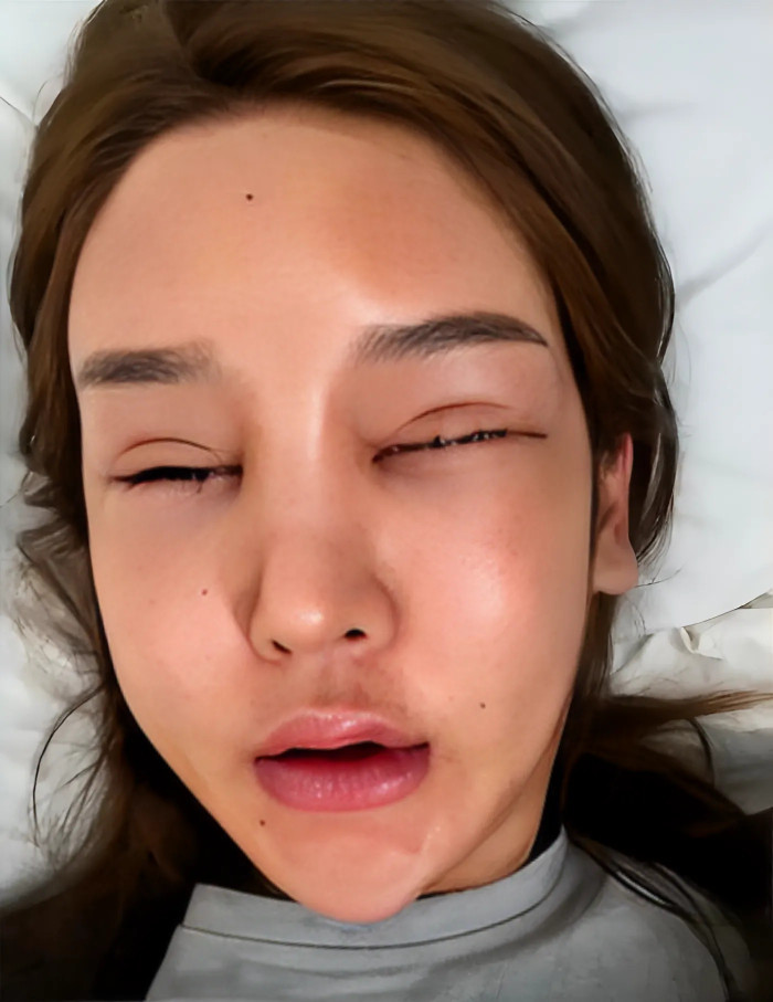 Đào Hoa Bảo Bảo biến dạng gương mặt nặng nề sau nhiều lần thẩm mỹ. (Ảnh: Sina)