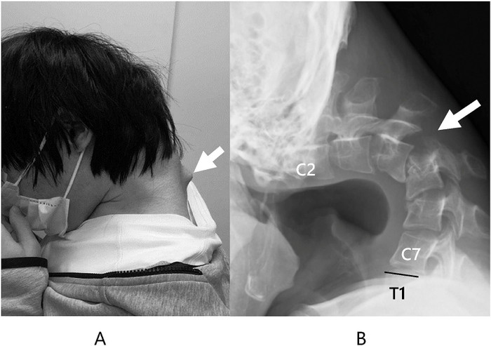 Chàng trai bị lệch cổ vì bấm điện thoại quá mức. 