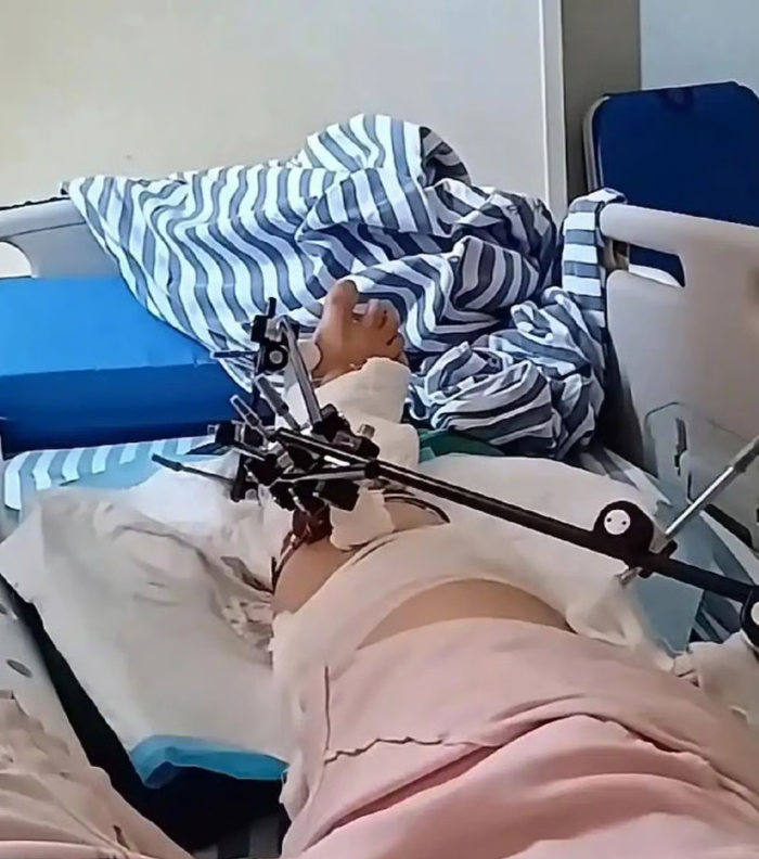 Người phụ nữ sống sót sau khi rơi từ tầng 12, bình phục sau 6 tháng Ảnh 2