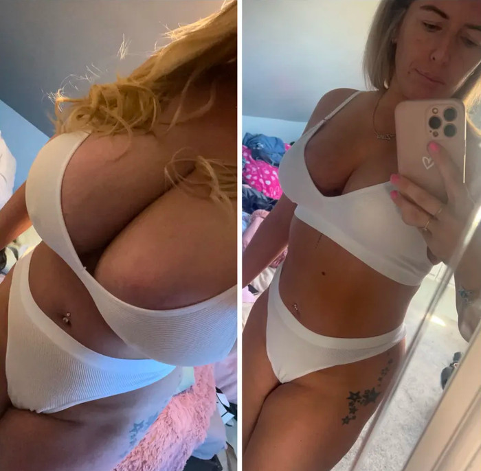 Zara Armstrong sau khi 'dao kéo', kích thước vòng 1 của cô đã thay đổi đáng kể. (Ảnh: The Sun)