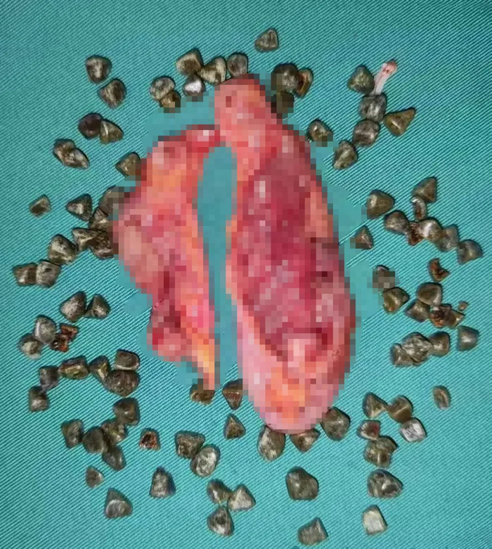 Bác sĩ sốc nặng khi phát hiện 95 viên sỏi trong túi mật của người phụ nữ 40 tuổi Ảnh 2