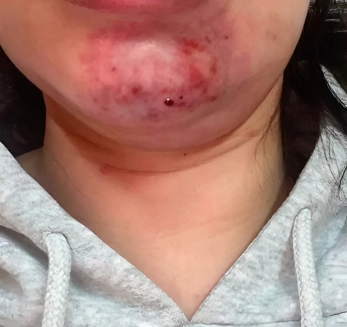 Cận cảnh phần cằm của Maryum Mohammad sau một thời gian điều trị. (Ảnh: Daily Mail)