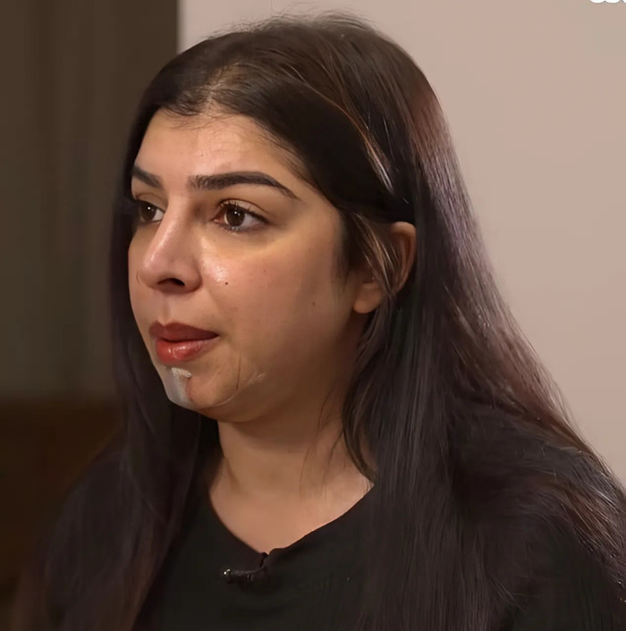 Maryum Mohammad đau đớn ở cằm, một vùng da xuất hiện mảng sẫm là dấu hiệu của hoại tử sau khi tiêm filler. (Ảnh: Daily Mail)